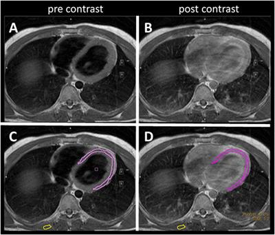 Cardiac Findings in Amyotrophic Lateral Sclerosis: A Magnetic Resonance Imaging Study